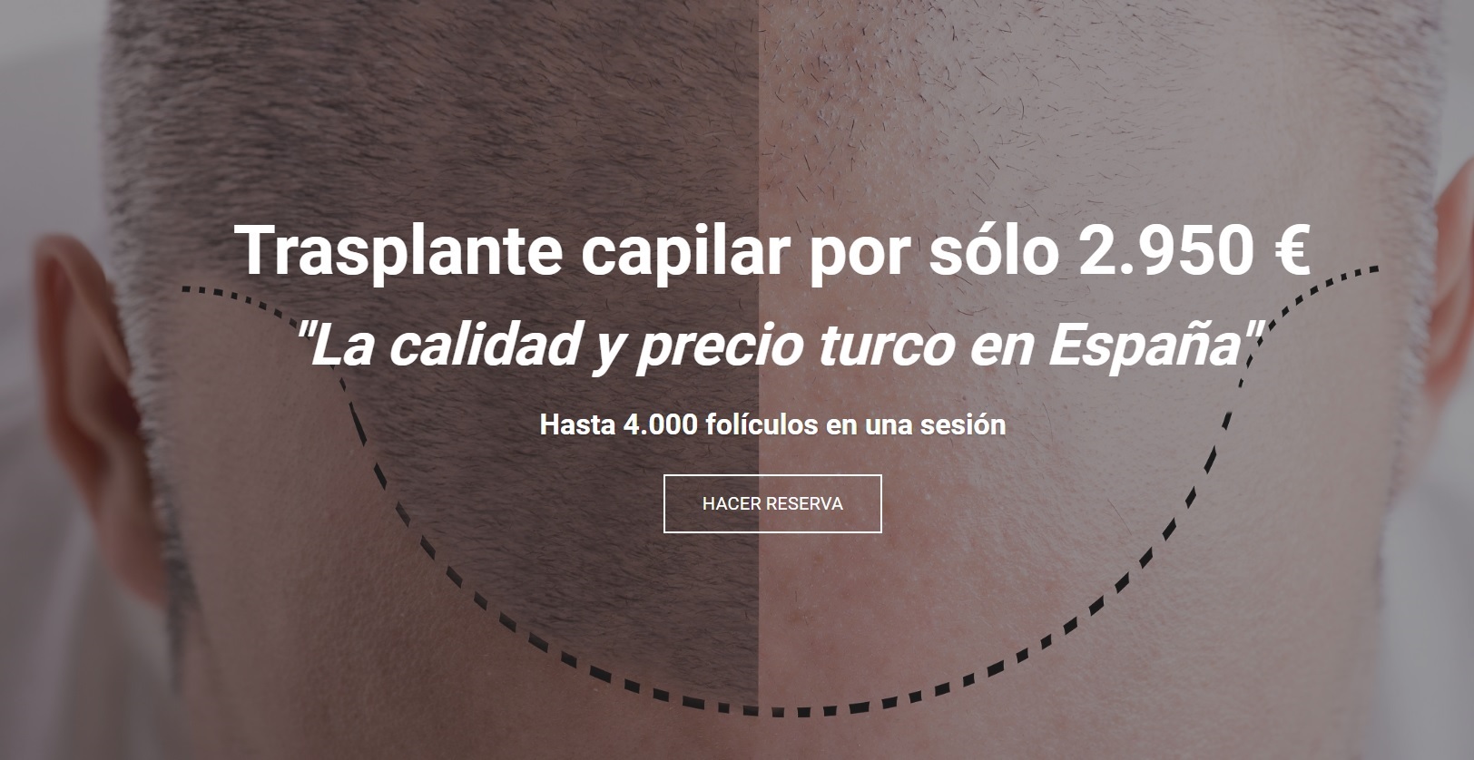 Estambul o el renacimiento del trasplante capilar, ahora en Málaga
