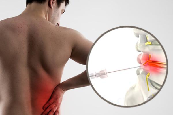 Tratamiento innovador para eliminar hernias discales en el día