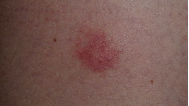 Pústulas en la piel provocadas por el virus