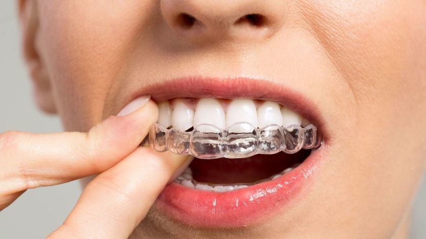 Los dentistas advierten de los peligros de la ortodoncia invisible que publicitan muchos influencers