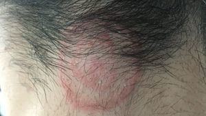 Dermatólogos alertan de un brote de tiña generado en las peluquerías masculinas