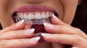 Los expertos alarman sobre los alineadores de ortodoncia 'low cost', de moda en internet