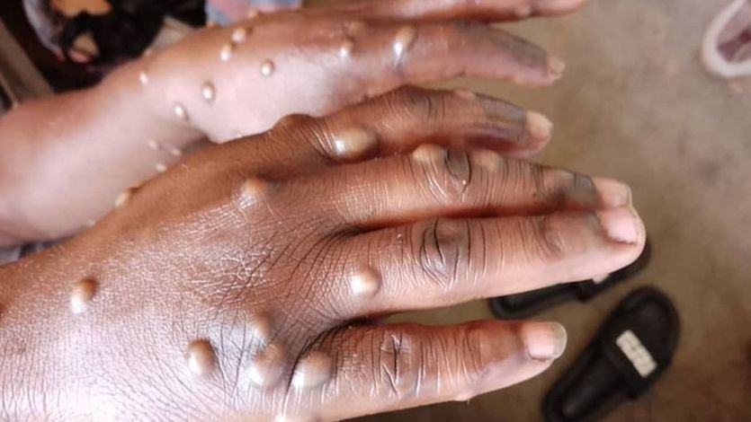Una mujer con mpox, antes conocida como viruela del mono