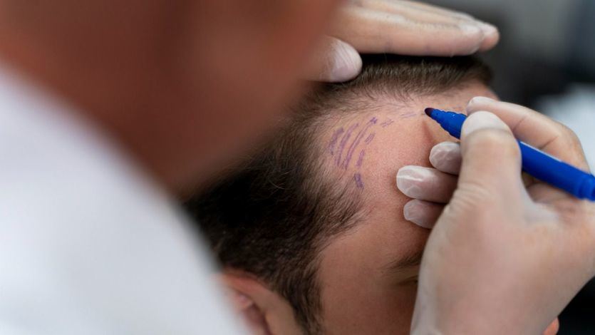 Hombre sometiéndose a trasplante capilar