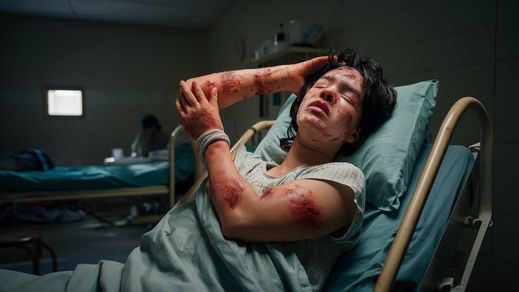 Persona con viruela del mono