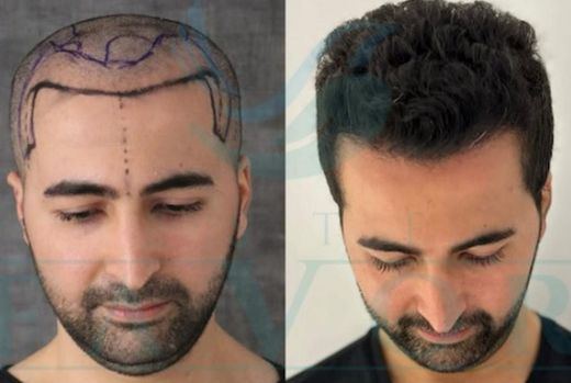 Turquía es tan popular en el trasplante capilar