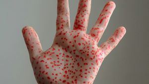 Sanidad intentará eliminar de nuevo el sarampión, enfermedad que llegó a estar erradicada