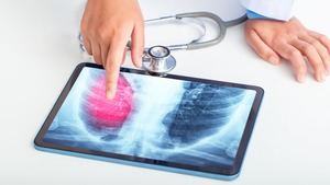 Alertan del "aumento descontrolado" de cáncer de pulmón en mujeres