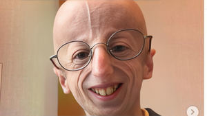 Muere el hombre más longevo con progeria, una enfermedad rara que produce el envejecimiento prematuro
