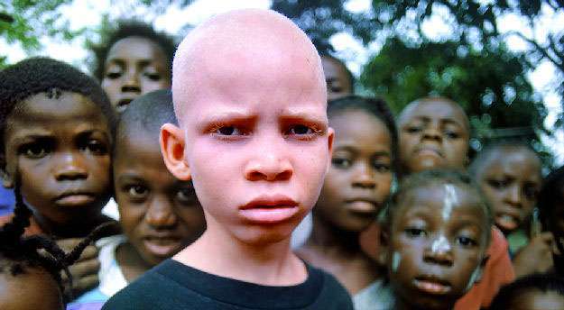 Los asesinatos rituales: la persecución del albinismo en África