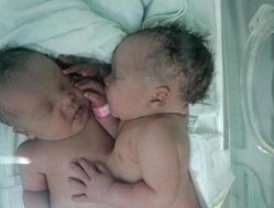 Nacen siamesas panameñas unidas por el tórax y comparten el corazón