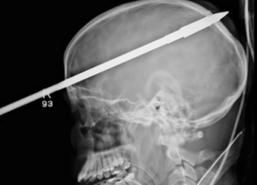 Un joven salva la vida tras clavarse un arpón en la cabeza 