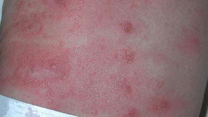 La sarna se multiplica en España por 50 entre 2011 y 2023