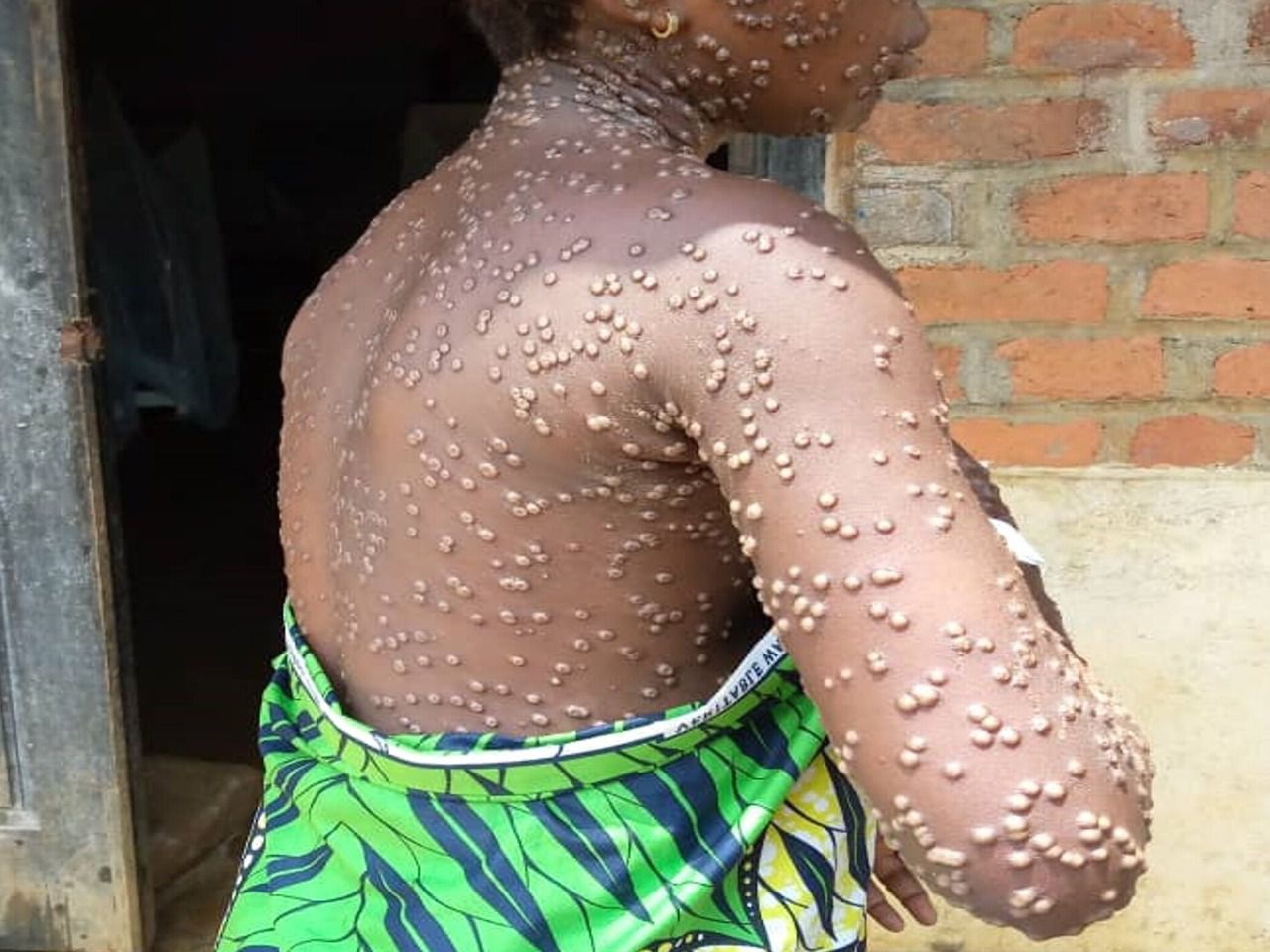 Una mujer con mpox, antes conocida como viruela del mono (Foto: Fundación Lucha contra las Infecciones)